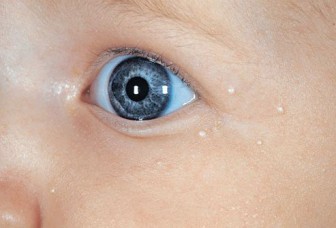 piccoli brufoli bianchi sulla faccia di un neonato