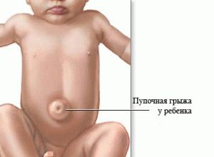 Símptomes d’hèrnia umbilical en nadons