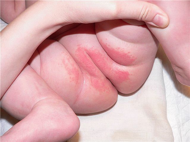 Come trattare l'eruzione da pannolino in un neonato