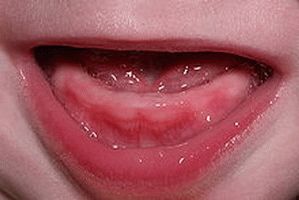 les dents es denten