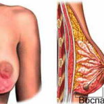 Simptomele mastitei