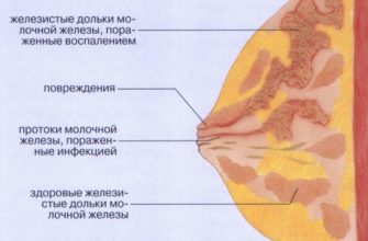lactostase mamária