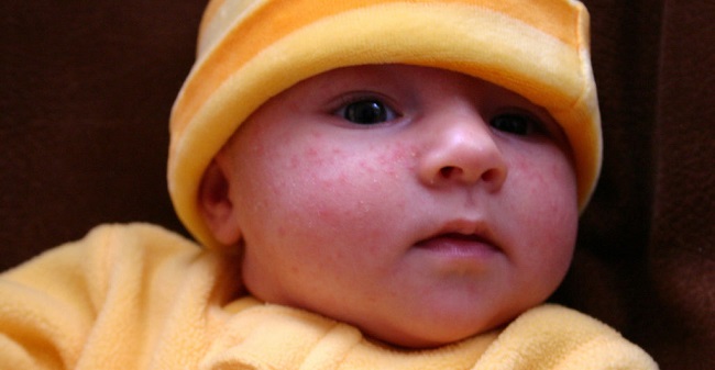 Mitos sobre Acne Recém-nascidos