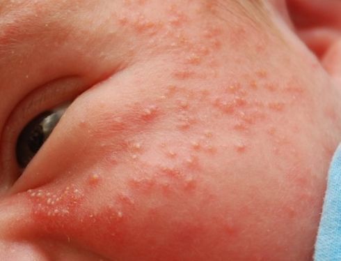 acne em recém-nascidos