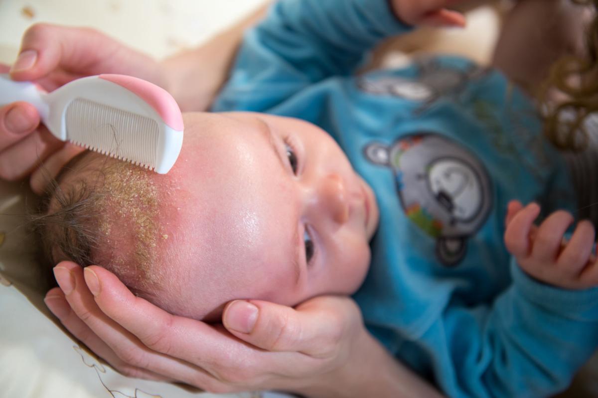 Dermatitis seborreica infantil